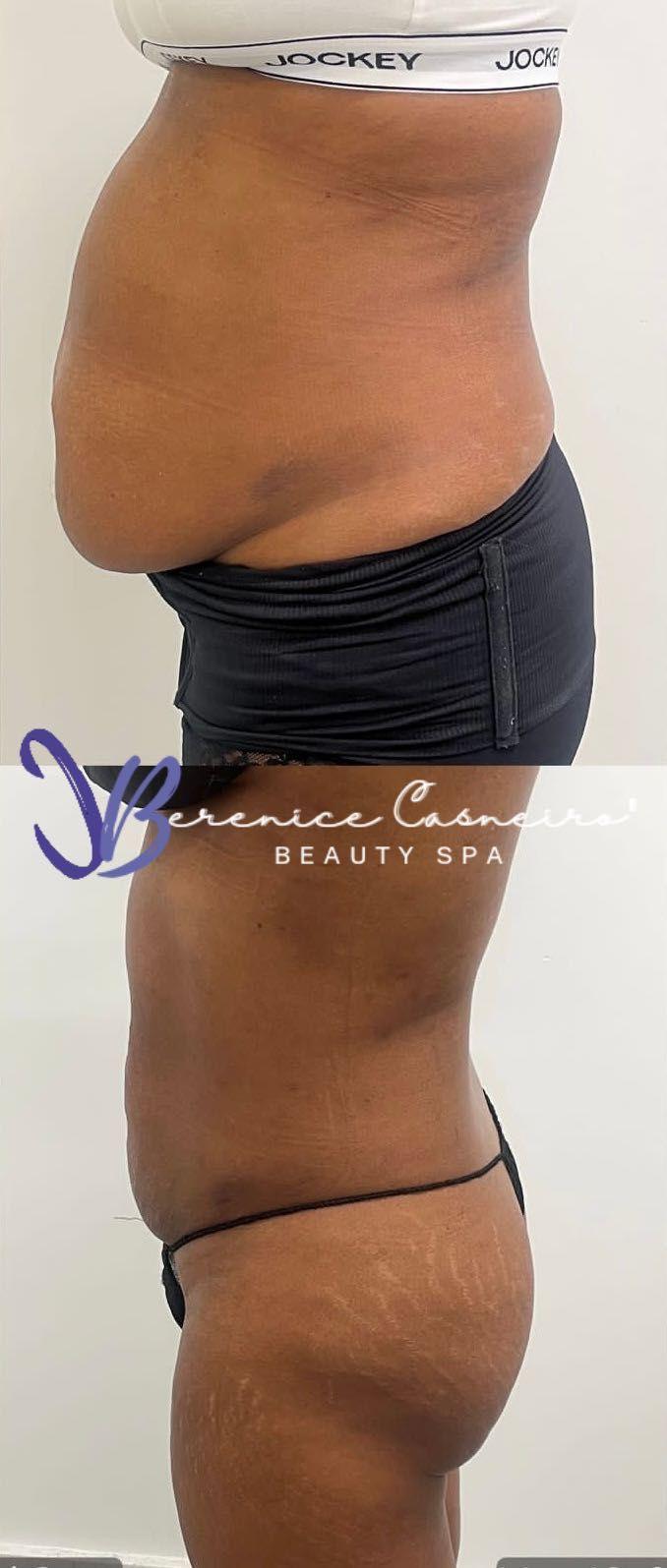 Body Contouring